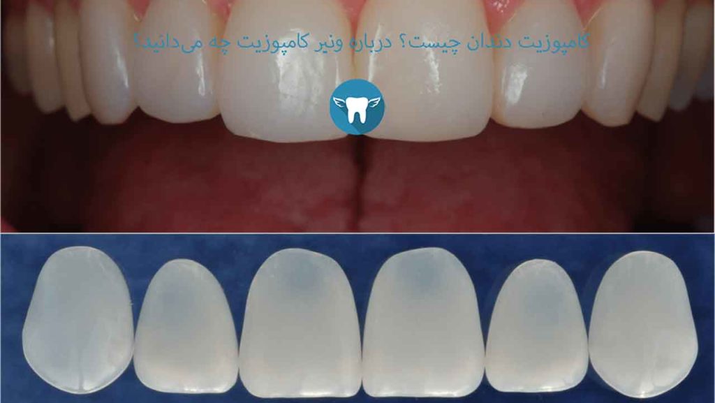 کامپوزیت دندان