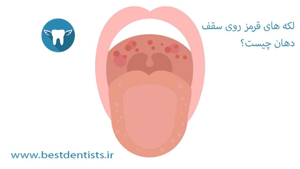 لکه های قرمز روی سقف دهان