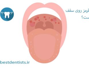 لکه های قرمز روی سقف دهان