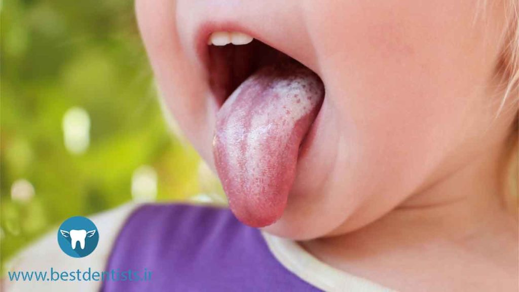 برفک دهان بر روی زبان کودک