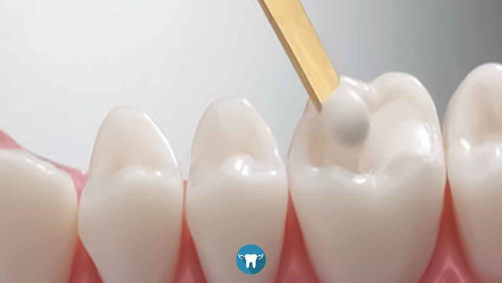 موارد استفاده از کامپوزیت دندان چیست؟