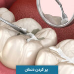 پر کردن دندان