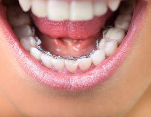 ارتودنسی دندان پایین
