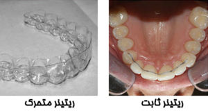 ارتودنسی ثابت دو فک با ریتینر