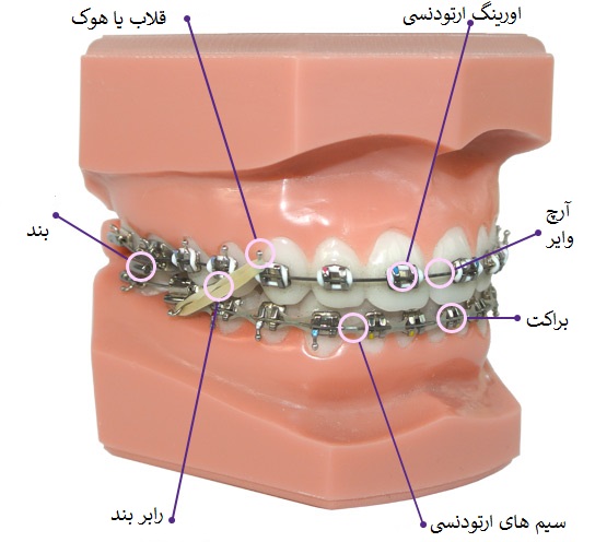 حلقه ارتودنسی-1