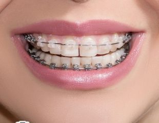 ارتودنسی و لاغری صورت