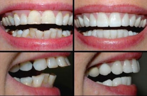 ارتودنسی چند دندان-2
