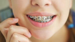 ارتودنسی دندان به روش خانگی