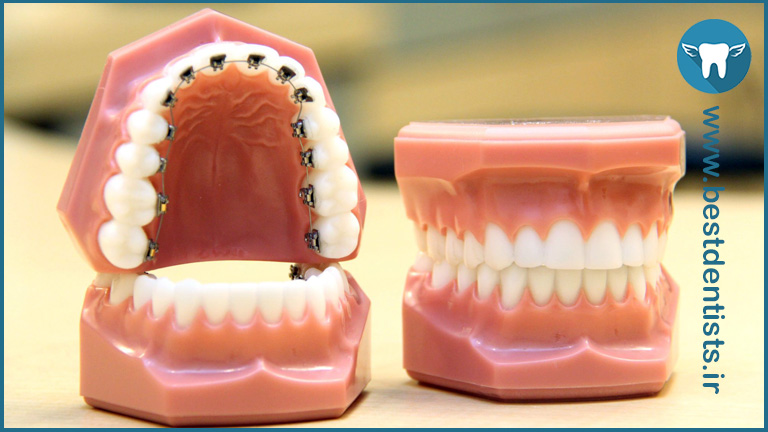 ارتودنسی ثابت با بریس پشت دندانی