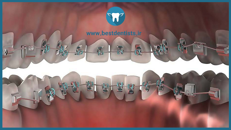 نصب براکت های ارتودنسی در پشت دندانها