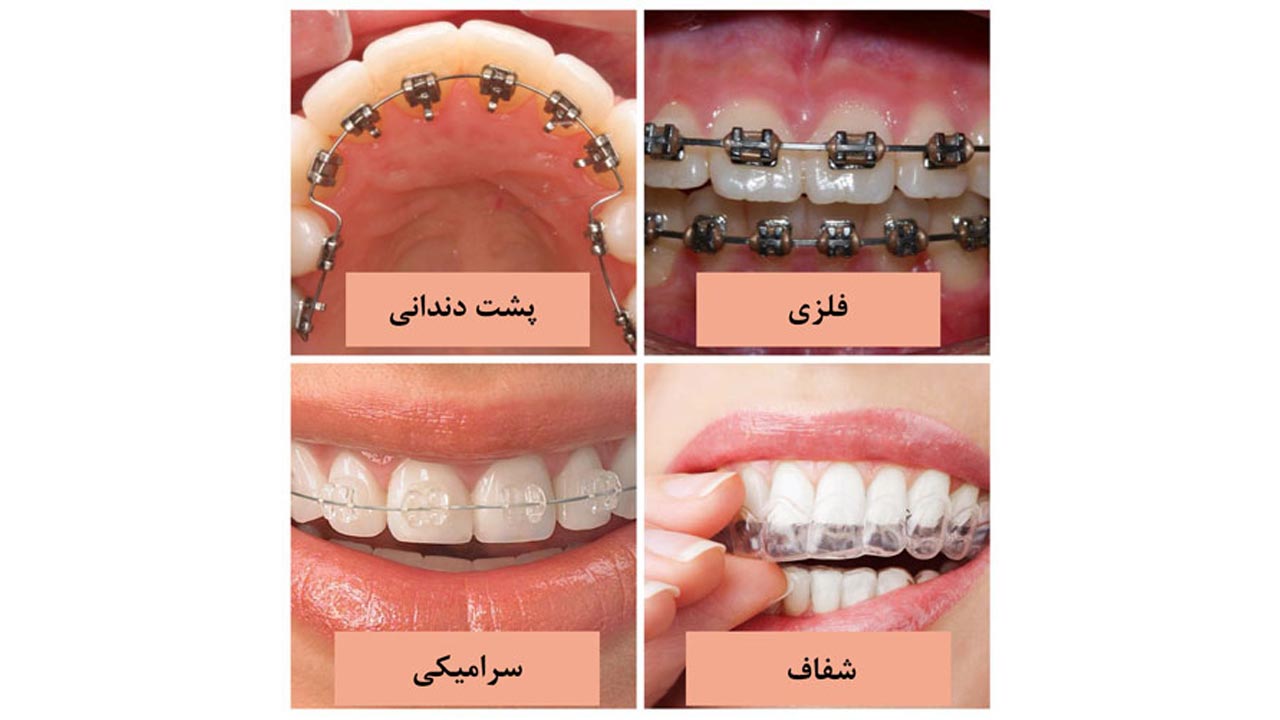 انواع ارتودنسی دندان
