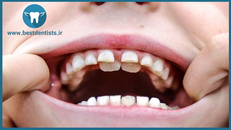 عوارض دندان های اضافی