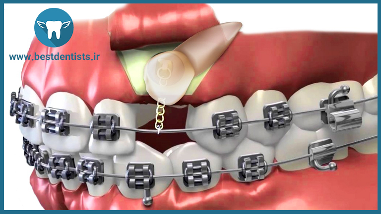 ارتودنسی دندان نیش پنهان