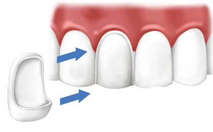 طریقه برش و قرارگیری لمینت دندان