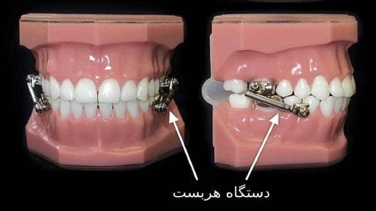 ارتودنسی دندان به روش خانگی-دستگاه هربست