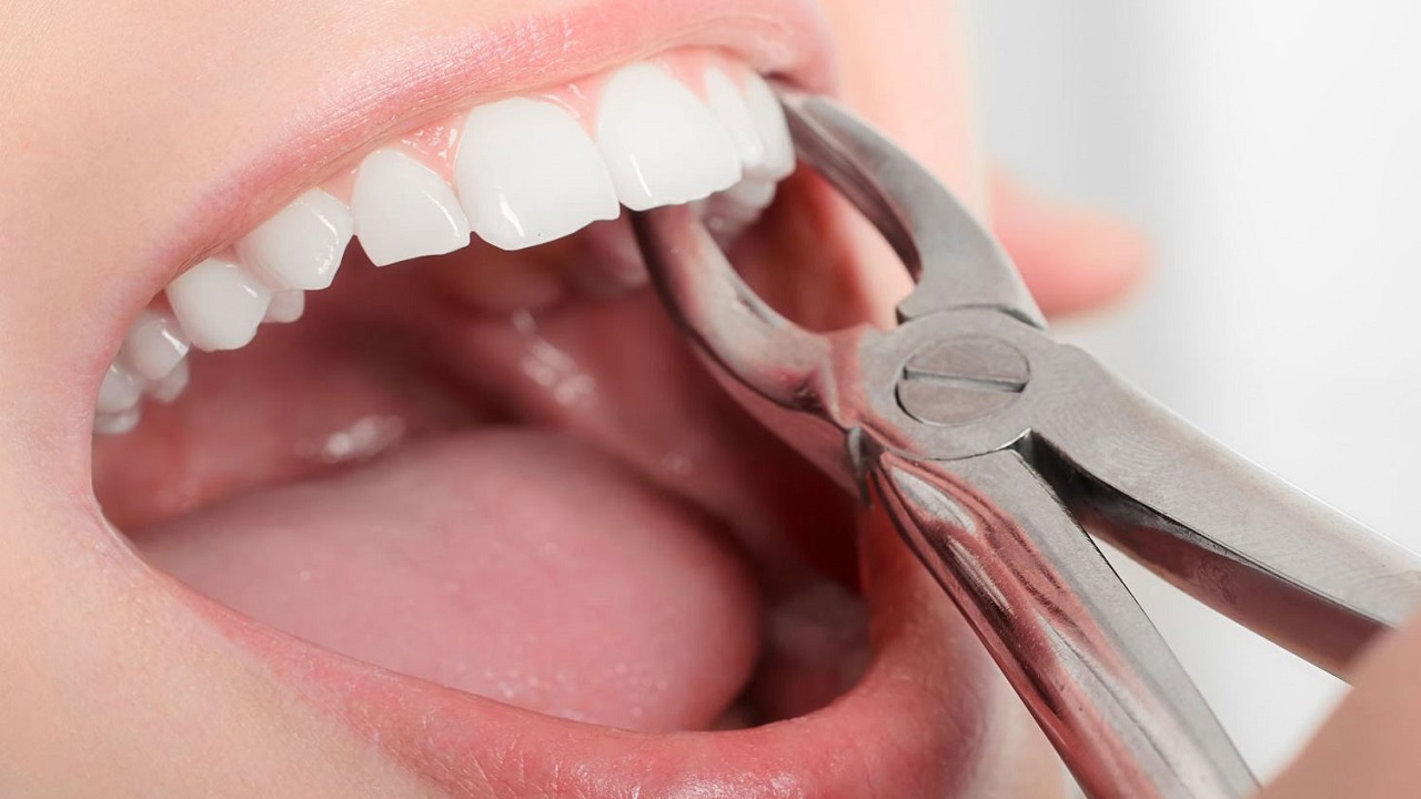 کشیدن دندان فرد در صورت لزوم برای ارتودنسی