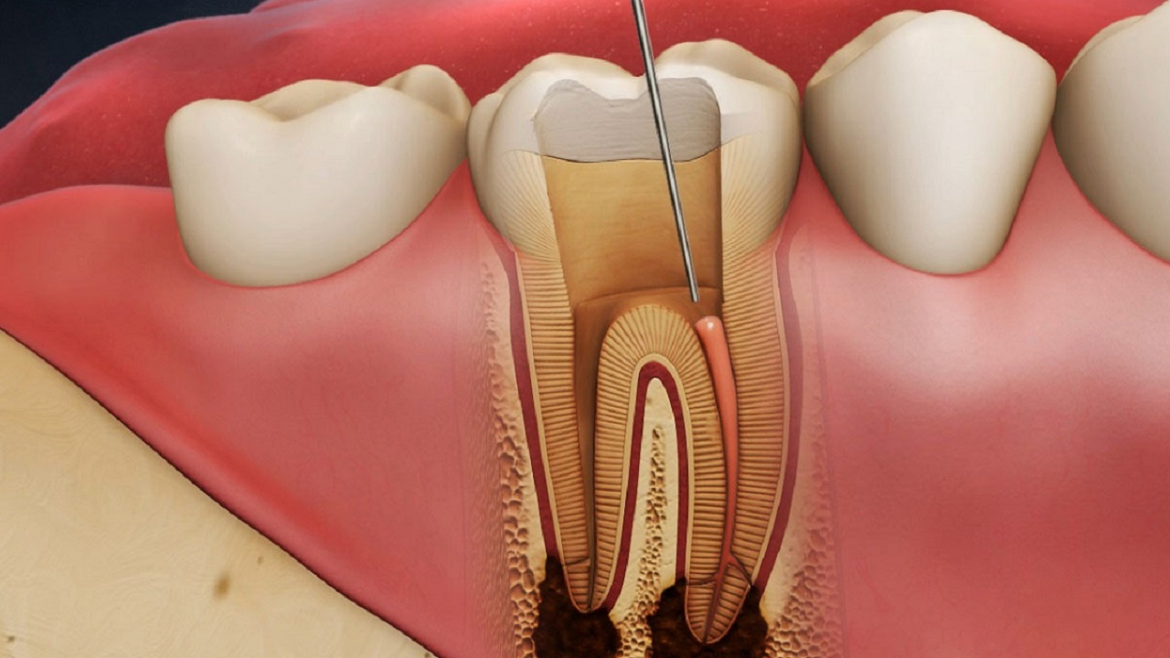 پر کردن کانال ریشه دندان با مواد مخصوص