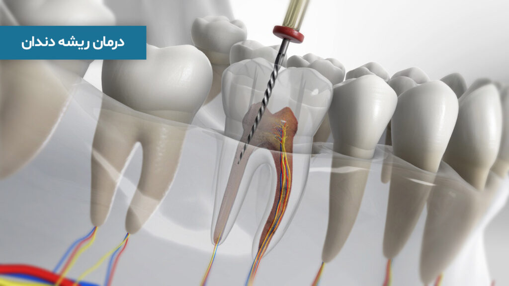 درمان ریشه دندان