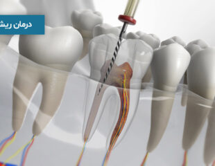 درمان ریشه دندان