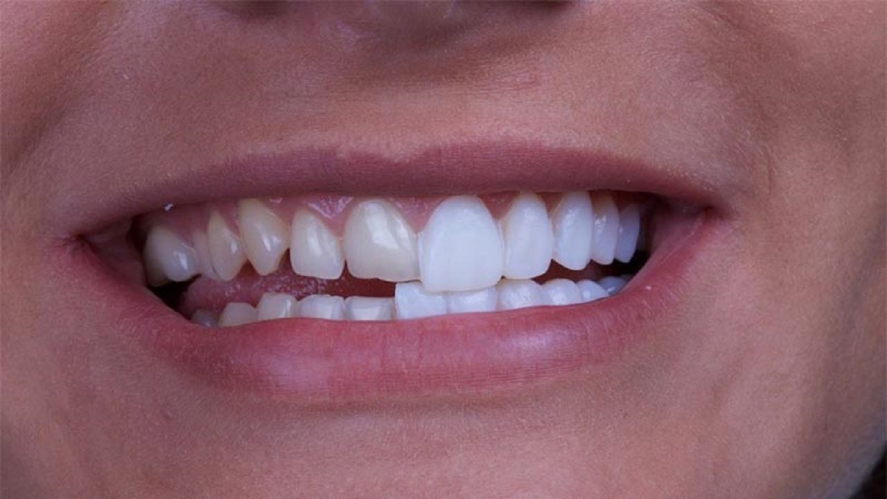 منظم سازی سایز دندان دندانها با استفاده از لمینت