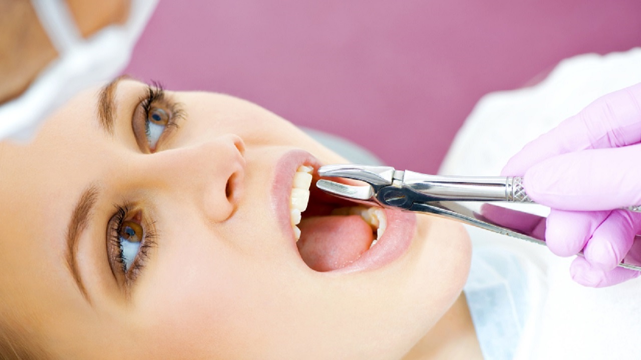 کشیدن دندان یک بیمار