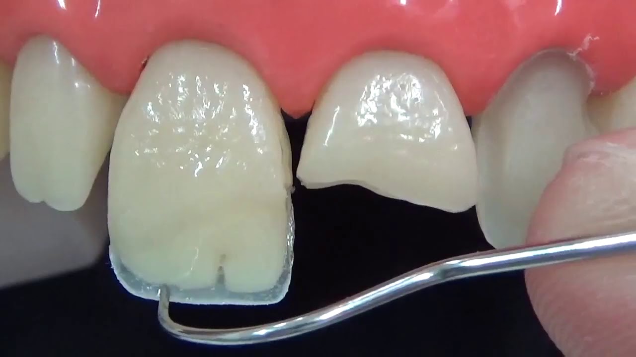 نصب و قرار دادن کامپوزیت دندان