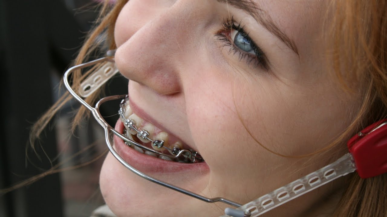 ارتودنسی دندان به روش خانگی-هدگیر ارتودنسی