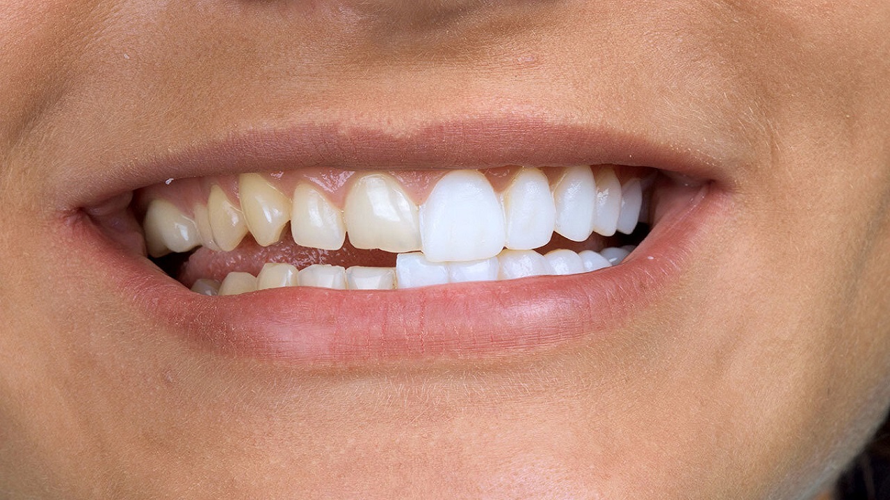 دندان کامپوزیت شده در مقایسه با دندان کامپوزیت نشده