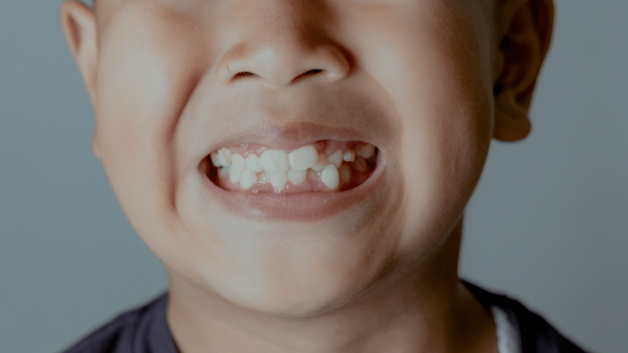 انواع شکل دندان های اضافی