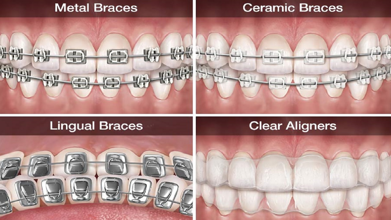 انواع ارتودنسی دندان