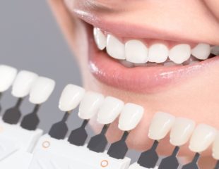 عوارض لمینت دندان چیست