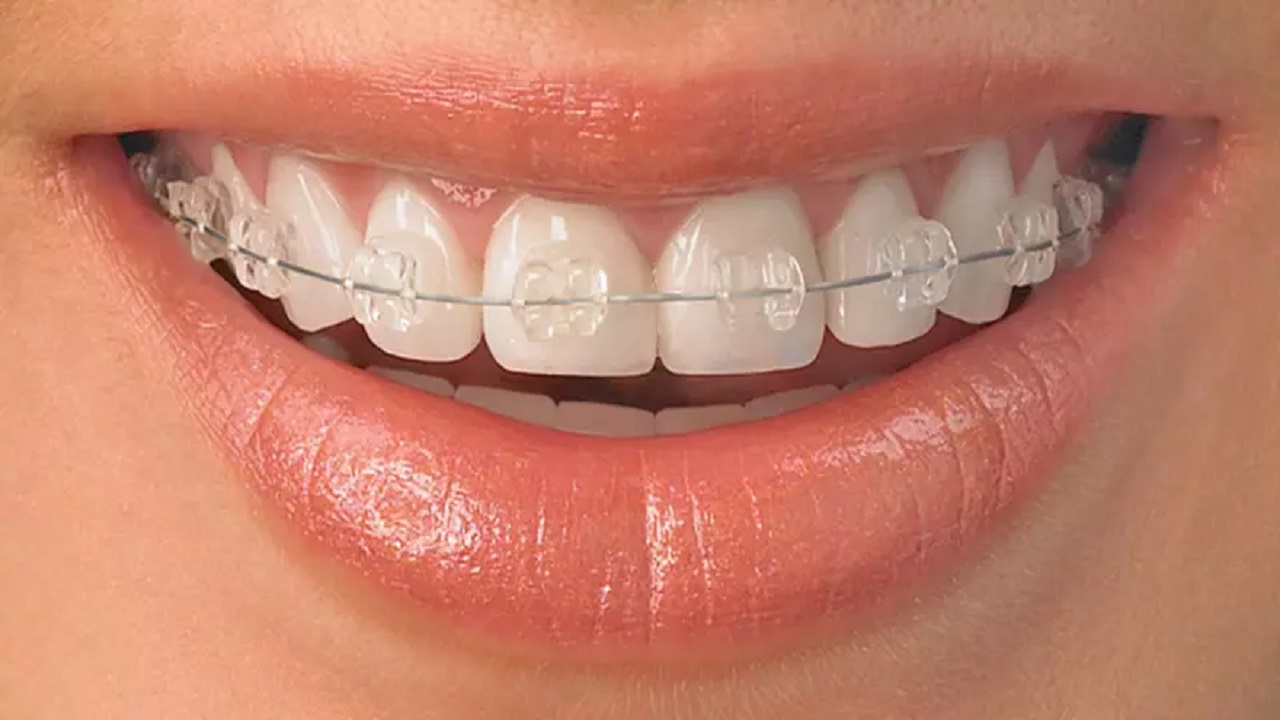 مزایای ارتودنسی با براکت همرنگ دندان