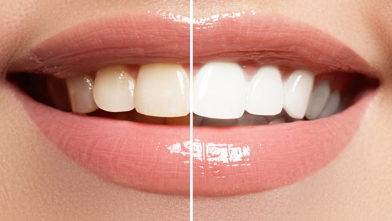 یکی از معیارهای  انتخاب رنگ لمینت دندان، رنگ دندان های اصلی فرد است.