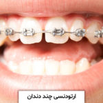 ارتودنسی چند دندان