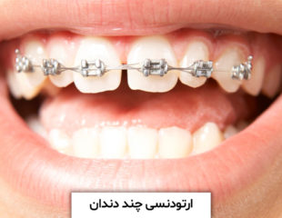 ارتودنسی چند دندان