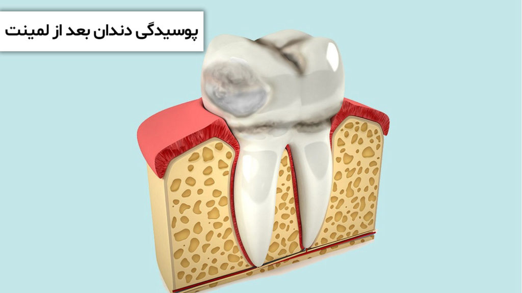 پوسیدگی دندان بعد از لمینت