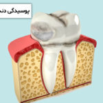 پوسیدگی دندان بعد از لمینت