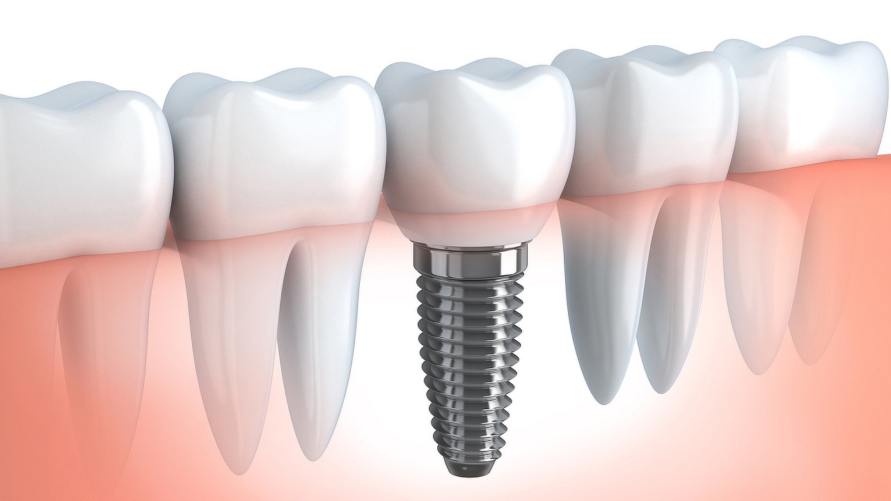 ایمپلنت دندان