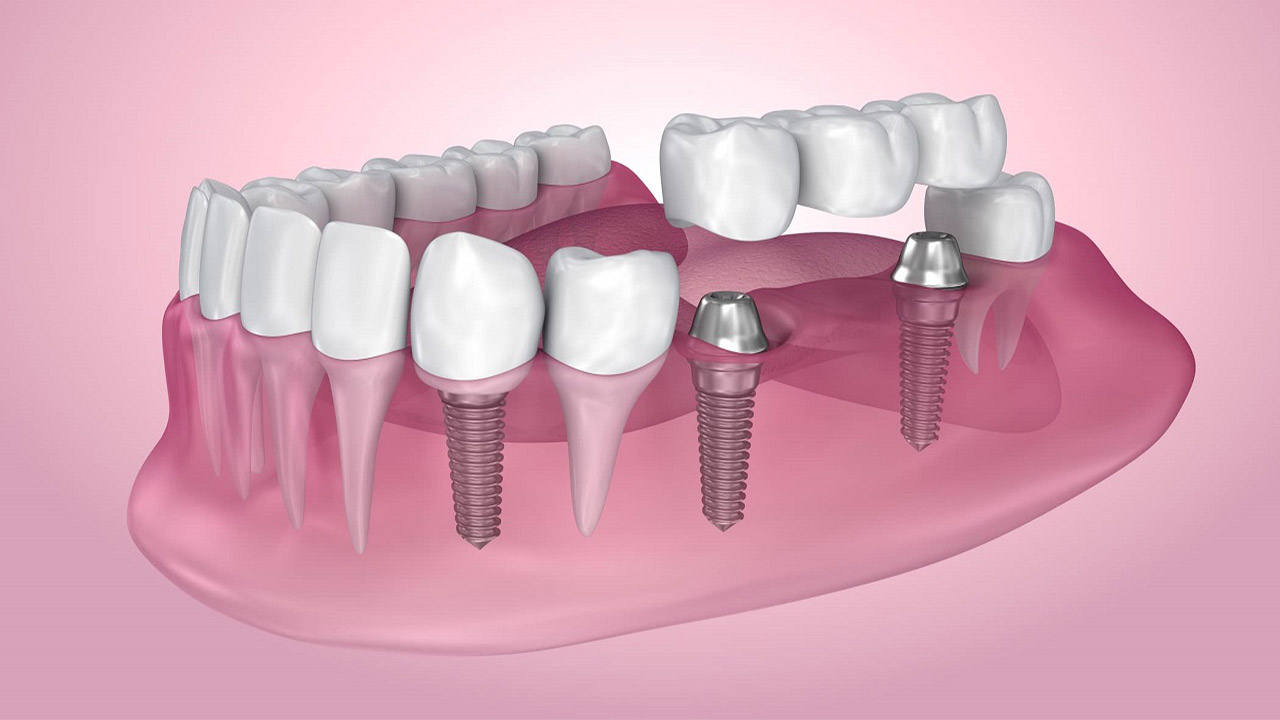 اجزای تشکیل دهنده ایمپلنت دندان