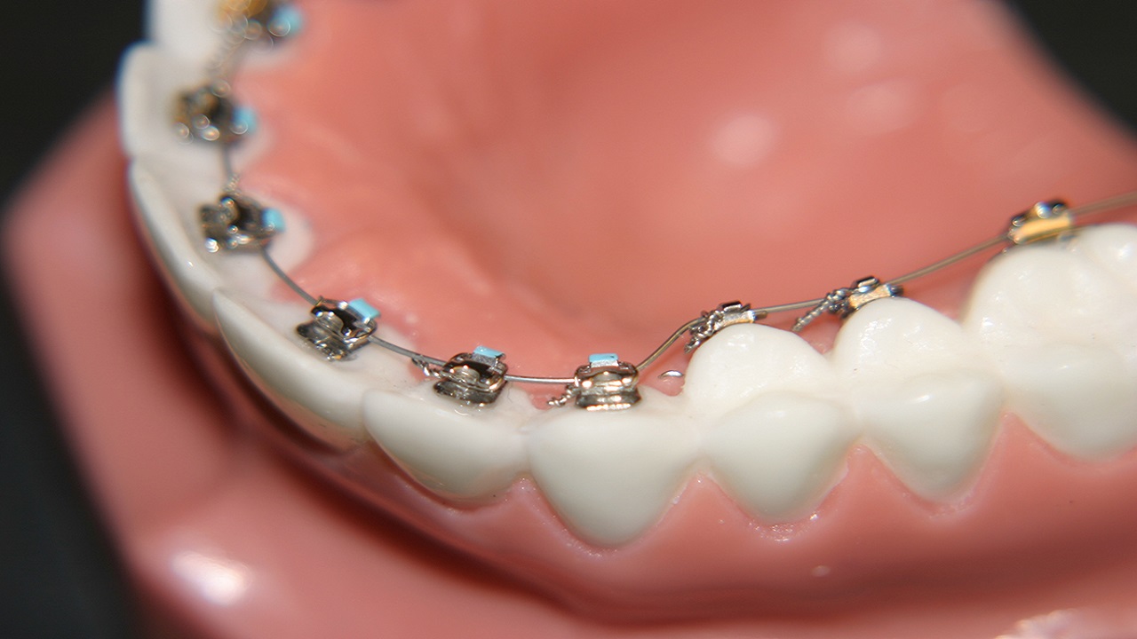 ارتودنسی پشت دندانی