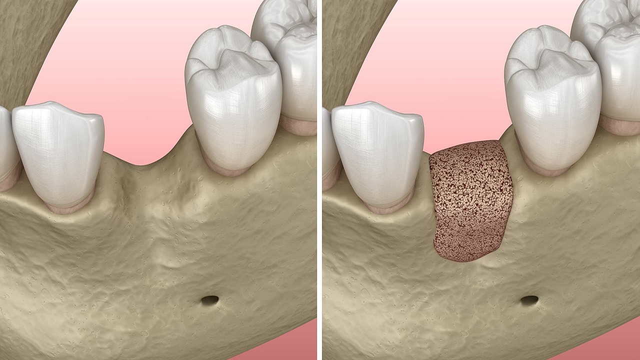 پیوند استخوان فک در ایمپلنت دندان