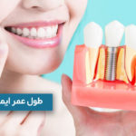 طول عمر ایمپلنت دندان