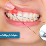 عفونت ایمپلنت دندان