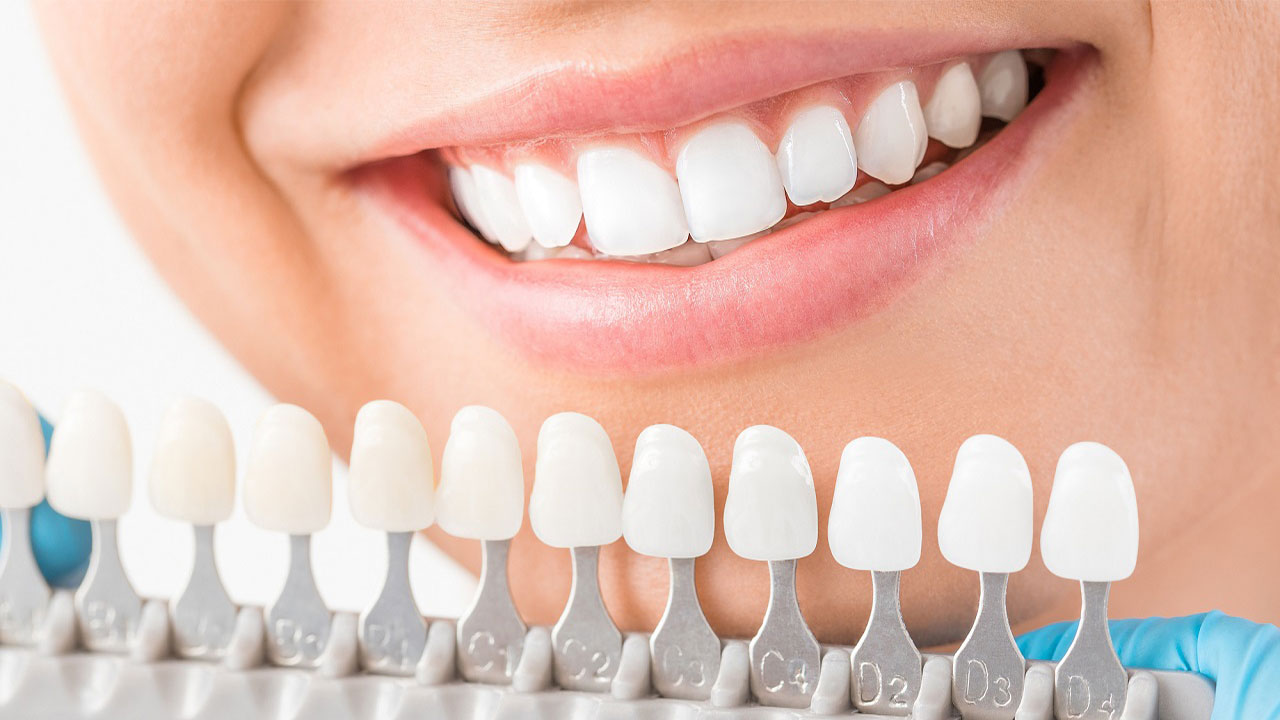 لمینت دندان روشی برای اصلاح طرح لبخند