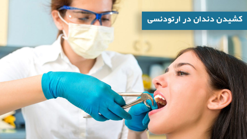 کشیدن دندان در ارتودنسی