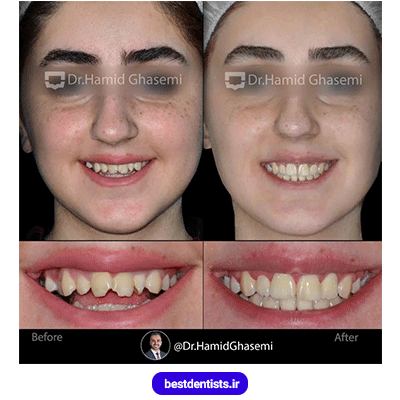 عکس قبل و بعد نمونه کار ارتودنسی دکتر حمید قاسمی