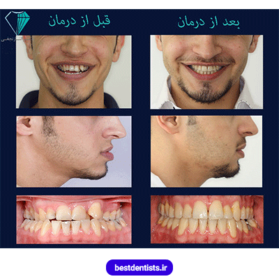 عکس قبل و بعد نمونه کار ارتودنسی دکتر الناز نجفی شماره 1