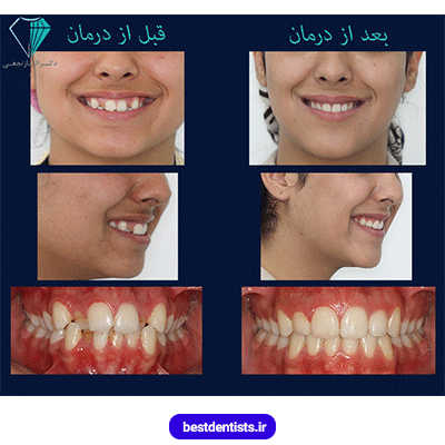 عکس قبل و بعد نمونه کار ارتودنسی دکتر الناز نجفی شماره 2