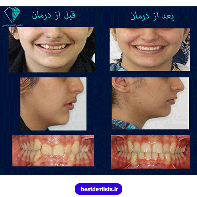 عکس قبل و بعد نمونه کار ارتودنسی دکتر الناز نجفی