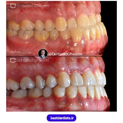 عکس قبل و بعد نمونه کار ارتودنسی دکتر حمید قاسمی شماره 1